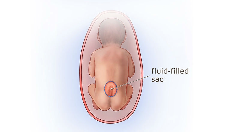 spina bifida