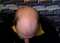 alopecia androgenica