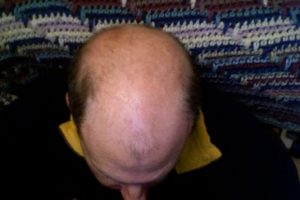 alopecia androgenica